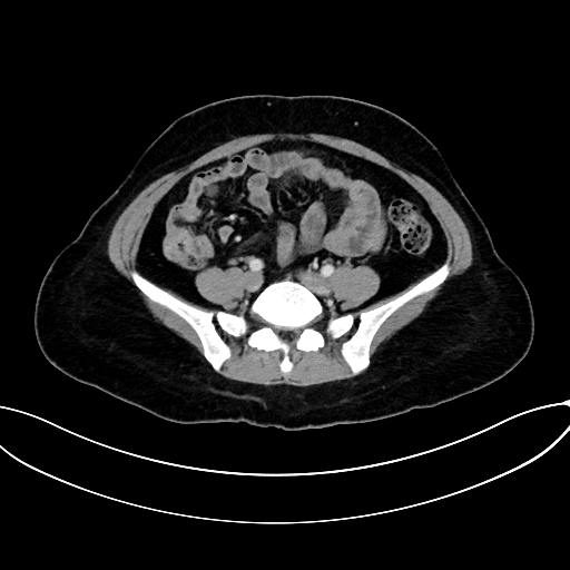 Adrenocortical carcinoma (Radiopaedia 87281-103569 Axial C+ portal venous phase 60).jpg