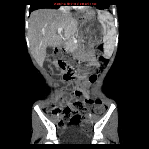 File:Adrenocortical carcinoma (Radiopaedia 9449-10131 Coronal C+ portal venous phase 3).jpg
