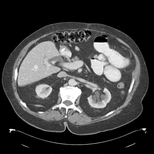 Adult ileal intussusception with secondary obstruction (Radiopaedia 30395-31051 Axial C+ portal venous phase 26).jpg