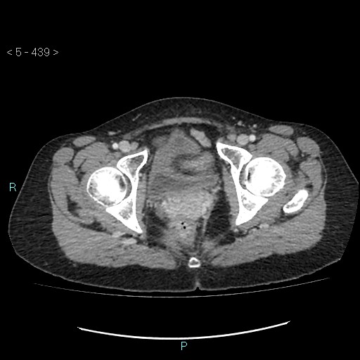 Adult transient intestinal intussusception (Radiopaedia 34853-36310 Axial C+ portal venous phase 117).jpg