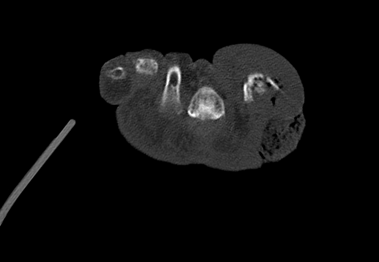 Advanced osteomyelitis due to open metatarsal fracture (Radiopaedia 83891-99095 Axial bone window 47).jpg