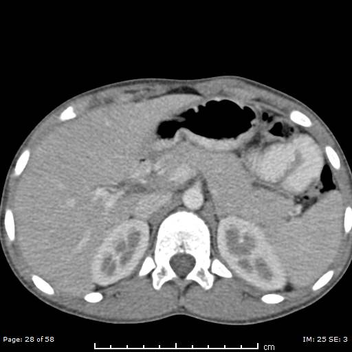 File:Agenesis of the gallbladder (Radiopaedia 55454-61905 B 28).jpg