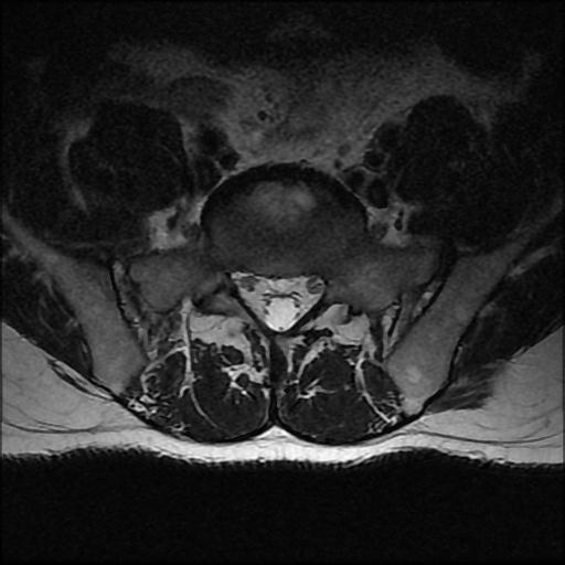 File:Aggressive vertebral hemangioma with pathological fracture (Radiopaedia 69528-79411 Axial T2 1).jpg