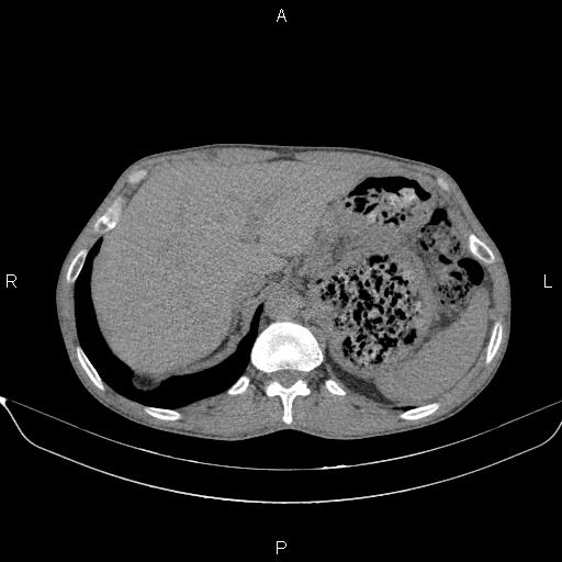Air bronchogram in pneumonia (Radiopaedia 85719-101512 Axial non-contrast 66).jpg