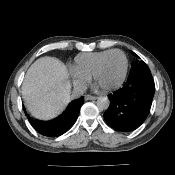 Airway foreign body in adult (Radiopaedia 85907-101779 Axial liver window 139).jpg