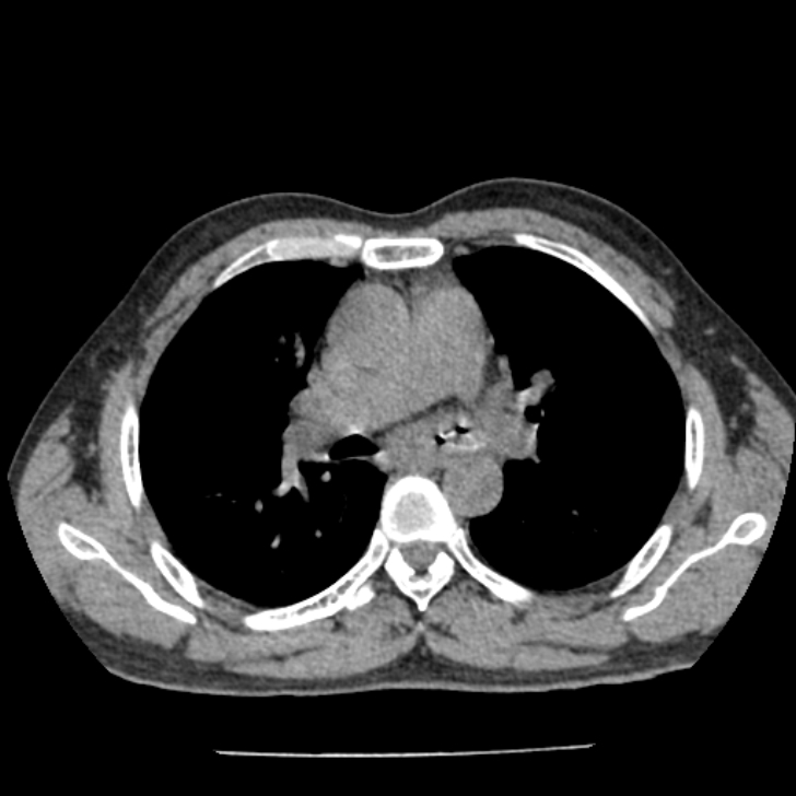 Airway foreign body in adult (Radiopaedia 85907-101779 Axial liver window 68).jpg