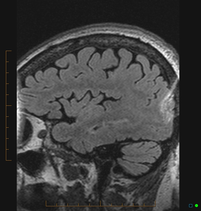 Aliasing artifact causing a spurious cerebellar lesion (Radiopaedia 48783-53810 Sagittal FLAIR 105).jpg