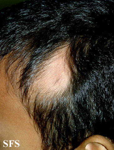 Alopecia Triangularis Congenita (Dermatology Atlas 1).jpg