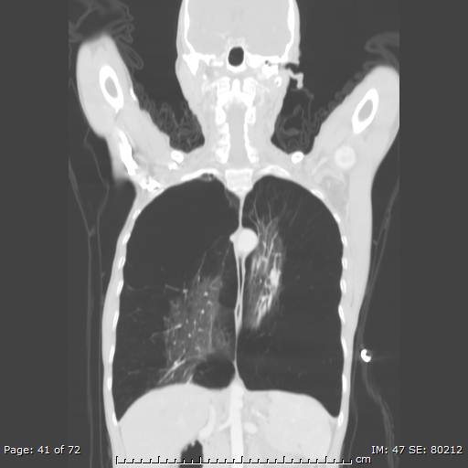 Alpha-1-antitrypsin deficiency (Radiopaedia 50561-55987 Coronal lung window 39).jpg