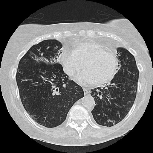Alpha-1-antitrypsin deficiency (Radiopaedia 72058-82557 Axial lung window 48).jpg