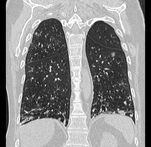 Alpha-1-antitrypsin deficiency (Radiopaedia 72058-82557 Coronal lung window 73).jpg