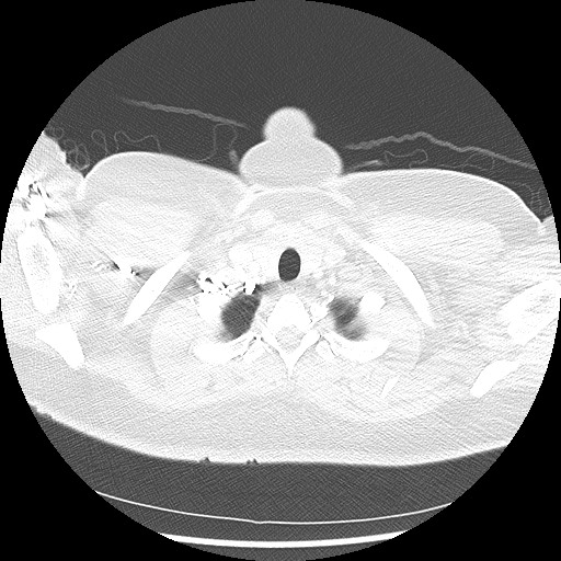 Alveolar soft part sarcoma - right leg (Radiopaedia 59432-67091 Axial lung window 10).jpg