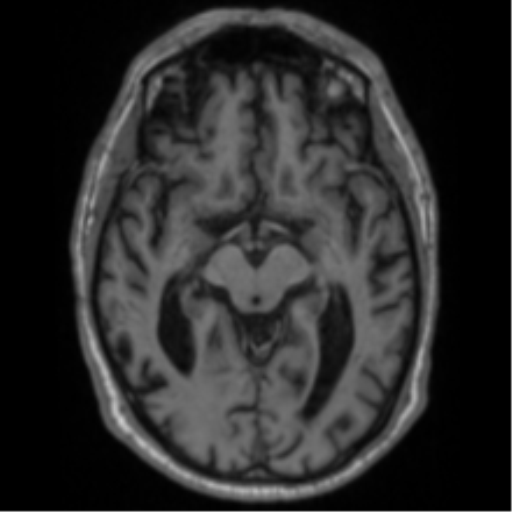 Alzheimer's disease- with Gerstmann syndrome and dressing apraxia (Radiopaedia 54882-61150 Axial T1 32).png