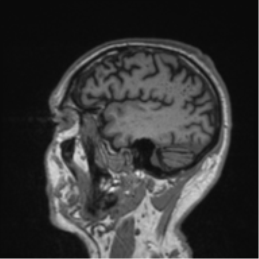 Alzheimer's disease- with Gerstmann syndrome and dressing apraxia (Radiopaedia 54882-61150 Sagittal T1 12).png