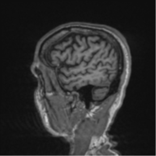 File:Alzheimer's disease- with apraxia (Radiopaedia 54763-61011 Sagittal T1 60).png