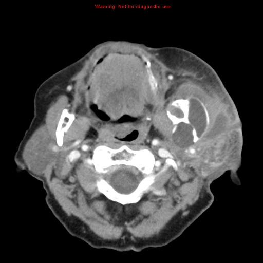 Ameloblastoma (Radiopaedia 27437-27631 A 30).jpg