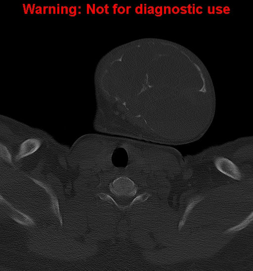 Ameloblastoma (Radiopaedia 33126-34164 Axial bone window 35).jpg