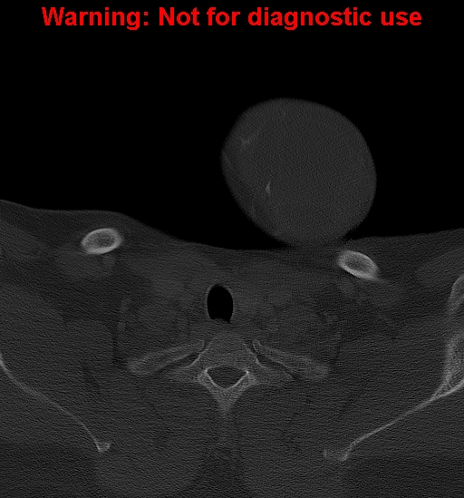 Ameloblastoma (Radiopaedia 33126-34164 Axial bone window 43).jpg