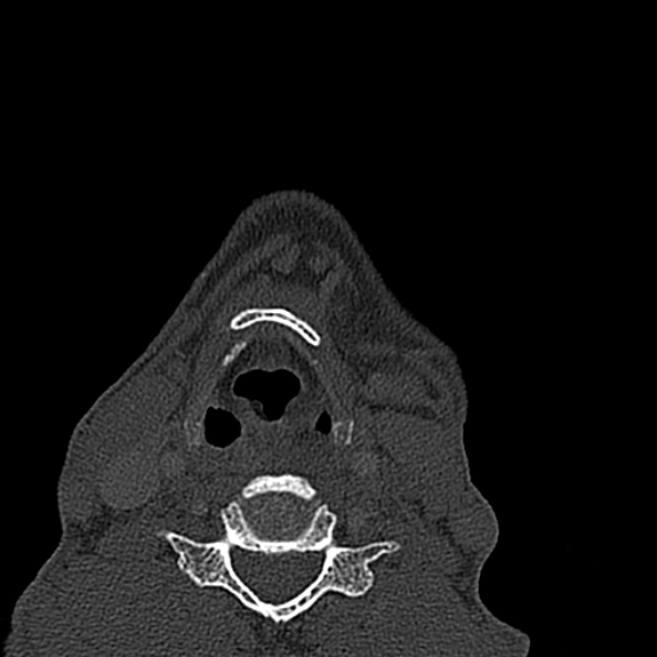 Ameloblastoma (Radiopaedia 51921-57766 Axial bone window 5).jpg
