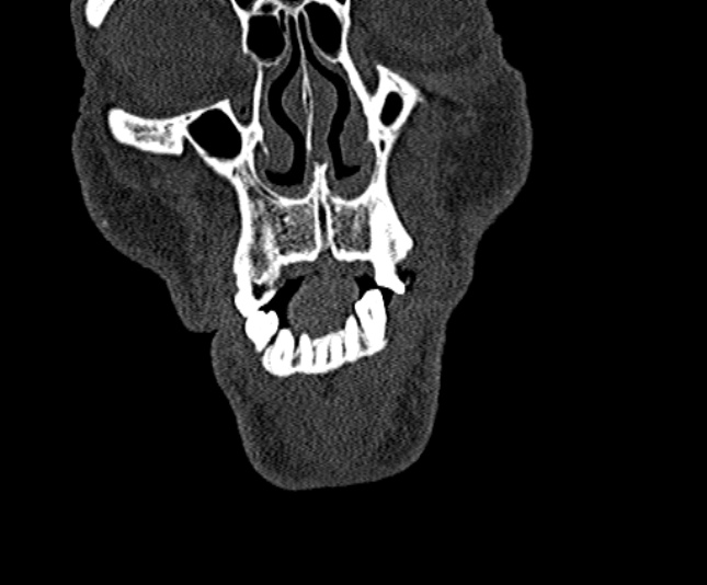 Ameloblastoma (Radiopaedia 51921-57766 Coronal bone window 26).jpg