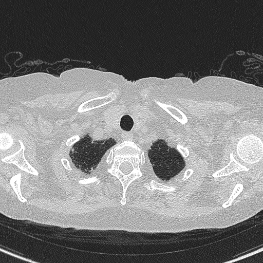 Amiodarone-induced pulmonary fibrosis (Radiopaedia 82355-96460 Axial lung window 6).jpg