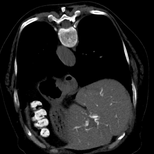 Ampullary adenocarcinoma (Radiopaedia 34013-35241 C 19).png