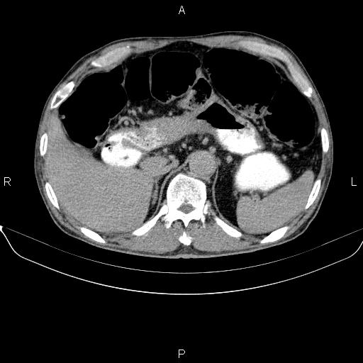 Ampullary adenocarcinoma (Radiopaedia 86093-102032 Axial C+ delayed 25).jpg