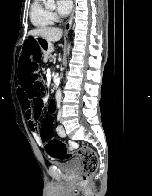 Ampullary adenocarcinoma (Radiopaedia 86093-102032 D 50).jpg