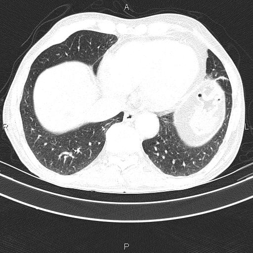 Ampullary adenocarcinoma (Radiopaedia 86093-102033 Axial lung window 45).jpg