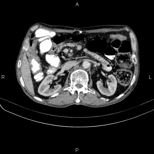 Ampullary adenocarcinoma (Radiopaedia 86093-102033 B 64).jpg