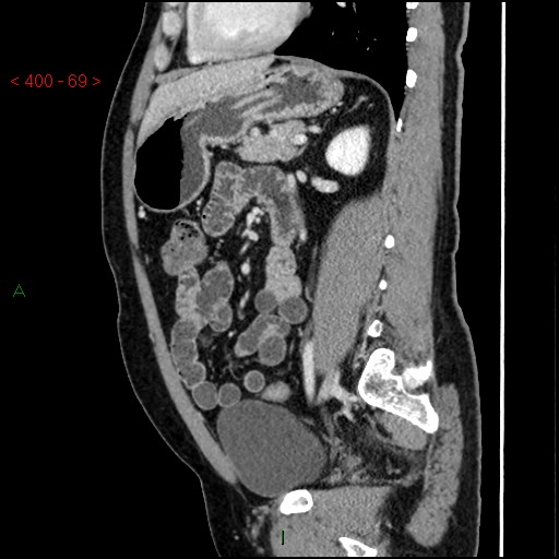 Ampullary carcinoma (Radiopaedia 56396-63056 D 68).jpg