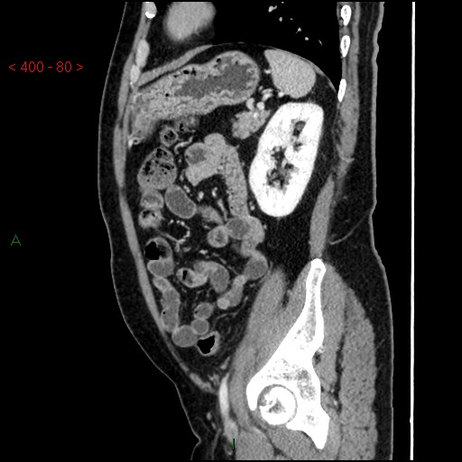 Ampullary carcinoma (Radiopaedia 56396-63056 D 79).jpg