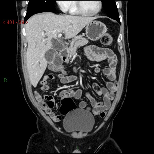 Ampullary carcinoma (Radiopaedia 56396-63056 E 38).jpg