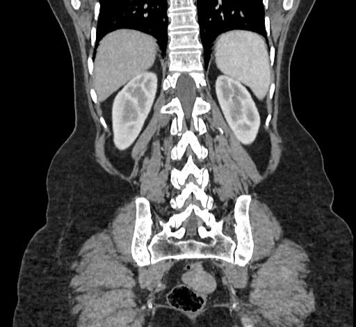 Ampullary tumor (Radiopaedia 60333-67998 B 62).jpg