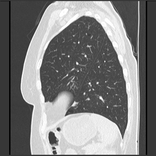 Amyloidosis - bronchial and diffuse nodular pulmonary involvement (Radiopaedia 60156-67744 F 43).jpg