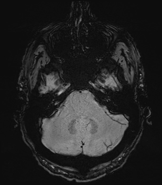Amyotrophic lateral sclerosis (Radiopaedia 87352-103658 Axial SWI 7).jpg