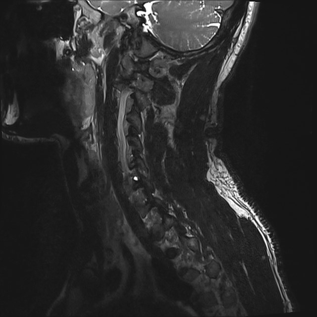 Amyotrophic lateral sclerosis (Radiopaedia 87352-103658 I 54).jpg