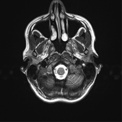 File:Anaplastic astrocytoma IDH mutant (Radiopaedia 50046-55341 Axial T2 5).png