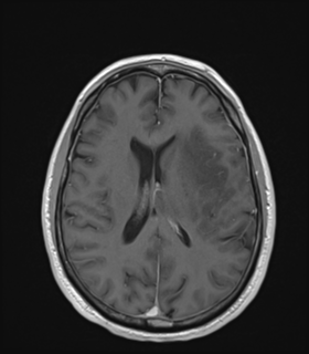 Anaplastic astrocytoma IDH wild-type (Radiopaedia 49984-55273 Axial T1 C+ 35).png