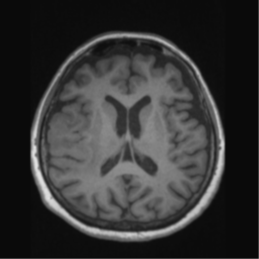 File:Anaplastic astrocytoma IDH wild-type (pseudoprogression) (Radiopaedia 42209-45276 Axial T1 89).png