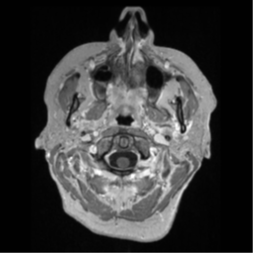 File:Anaplastic astrocytoma IDH wild-type (pseudoprogression) (Radiopaedia 42209-45276 Axial T1 C+ 9).png