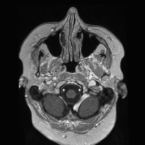 File:Anaplastic astrocytoma IDH wild-type (pseudoprogression) (Radiopaedia 42209-45278 Axial T1 C+ 27).png