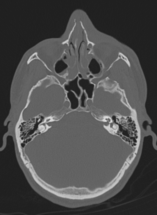 Anaplastic oligodendroglioma with skull fracture (Radiopaedia 74831-85846 Axial bone window 58).png