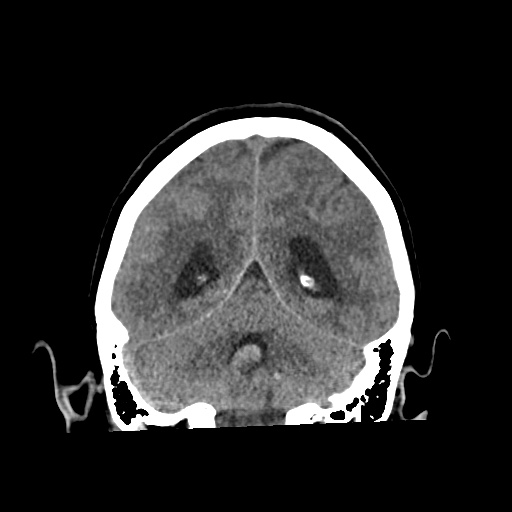 Aneursym related subarachnoid hemorrhage with hydrocephalus (Radiopaedia 45105-49083 Coronal non-contrast 46).jpg