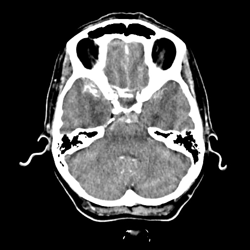 Aneursym related subarachnoid hemorrhage with hydrocephalus (Radiopaedia 45105-49084 D 14).jpg