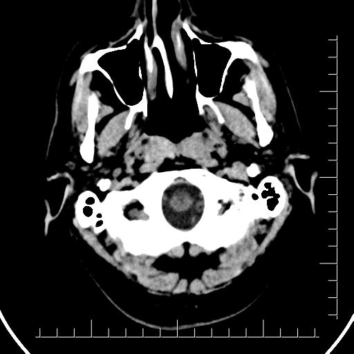 Aneurysm of posterior communicating artery (Radiopaedia 20188-20162 Axial non-contrast 3).jpg
