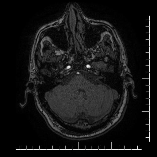 File:Aneurysm of posterior communicating artery (Radiopaedia 20188-20163 Axial MRA 56).jpg