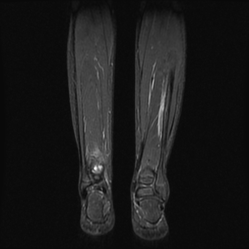 File:Aneurysmal bone cyst - tibia (Radiopaedia 22343-22367 Coronal STIR 13).jpg