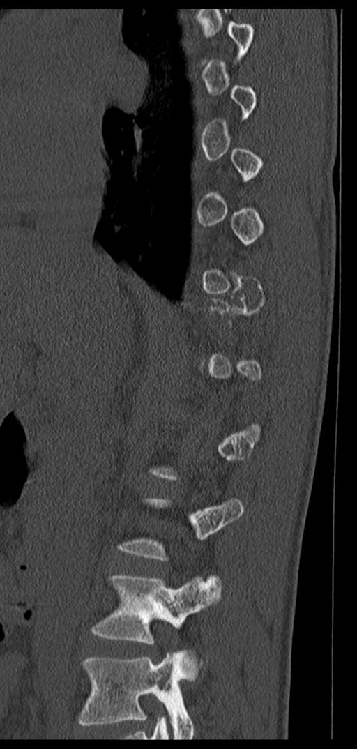 Aneurysmal bone cyst T11 (Radiopaedia 29294-29721 Sagittal bone window 53).jpg