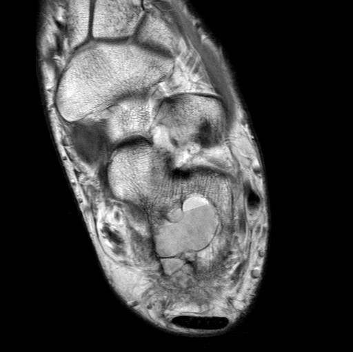 File:Aneurysmal bone cyst of the calcaneus (Radiopaedia 60669-68420 Axial PD 14).jpg